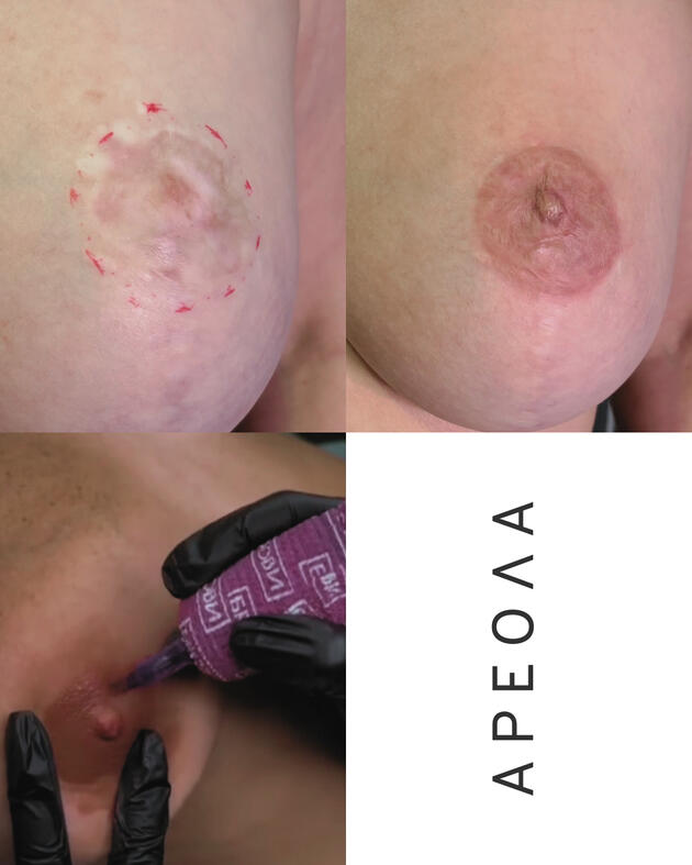 3D медицински татуировки | Eliz Tattoo Studio